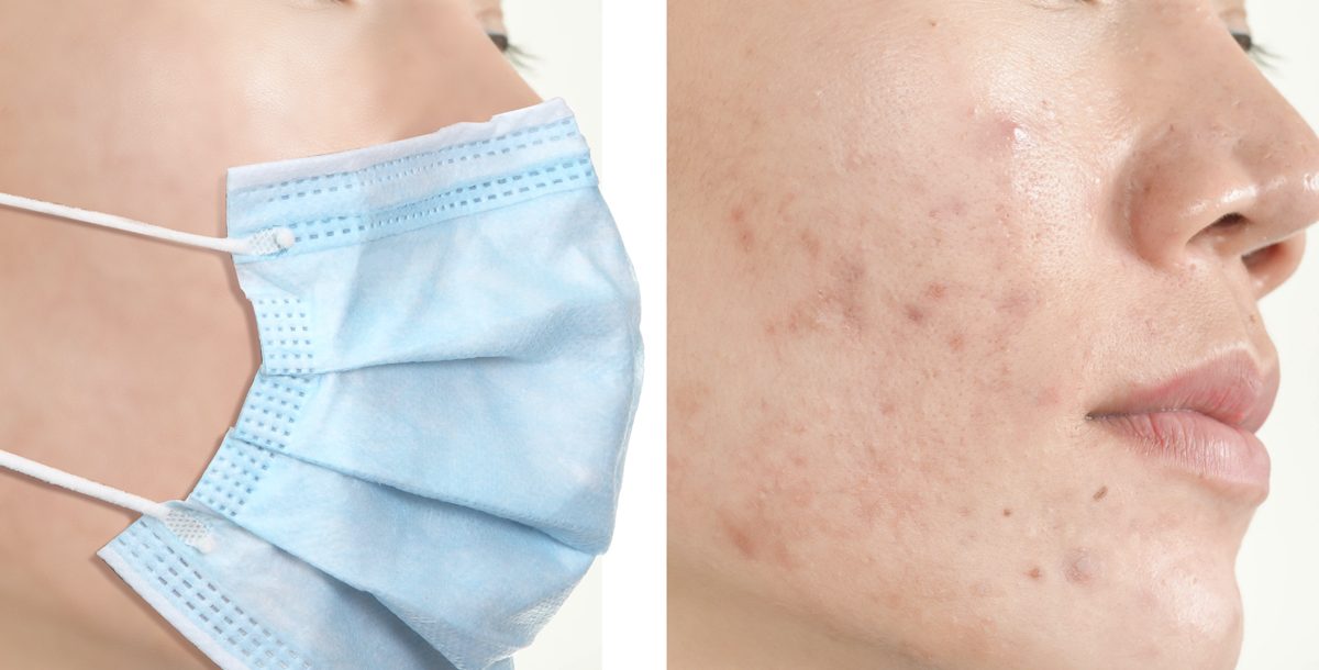 7 Cara Menghindari Jerawat Akibat Masker (Maskne)